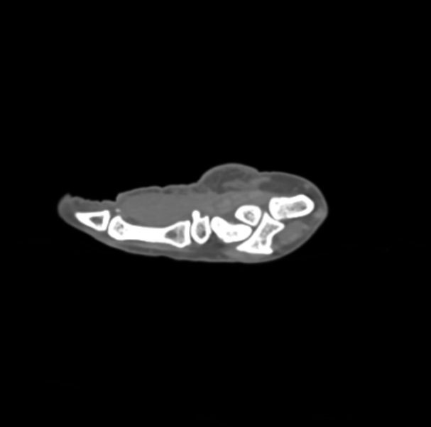Wrist CT preview